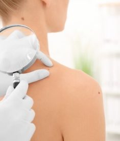 Skin checks, Liquid Nitrogen